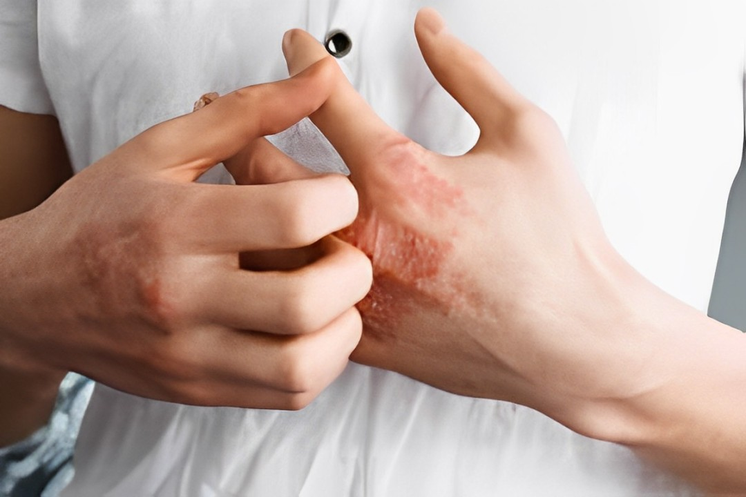 LEO Pharma's Chronic Hand Eczema Study Makes Headlines In The Lancet