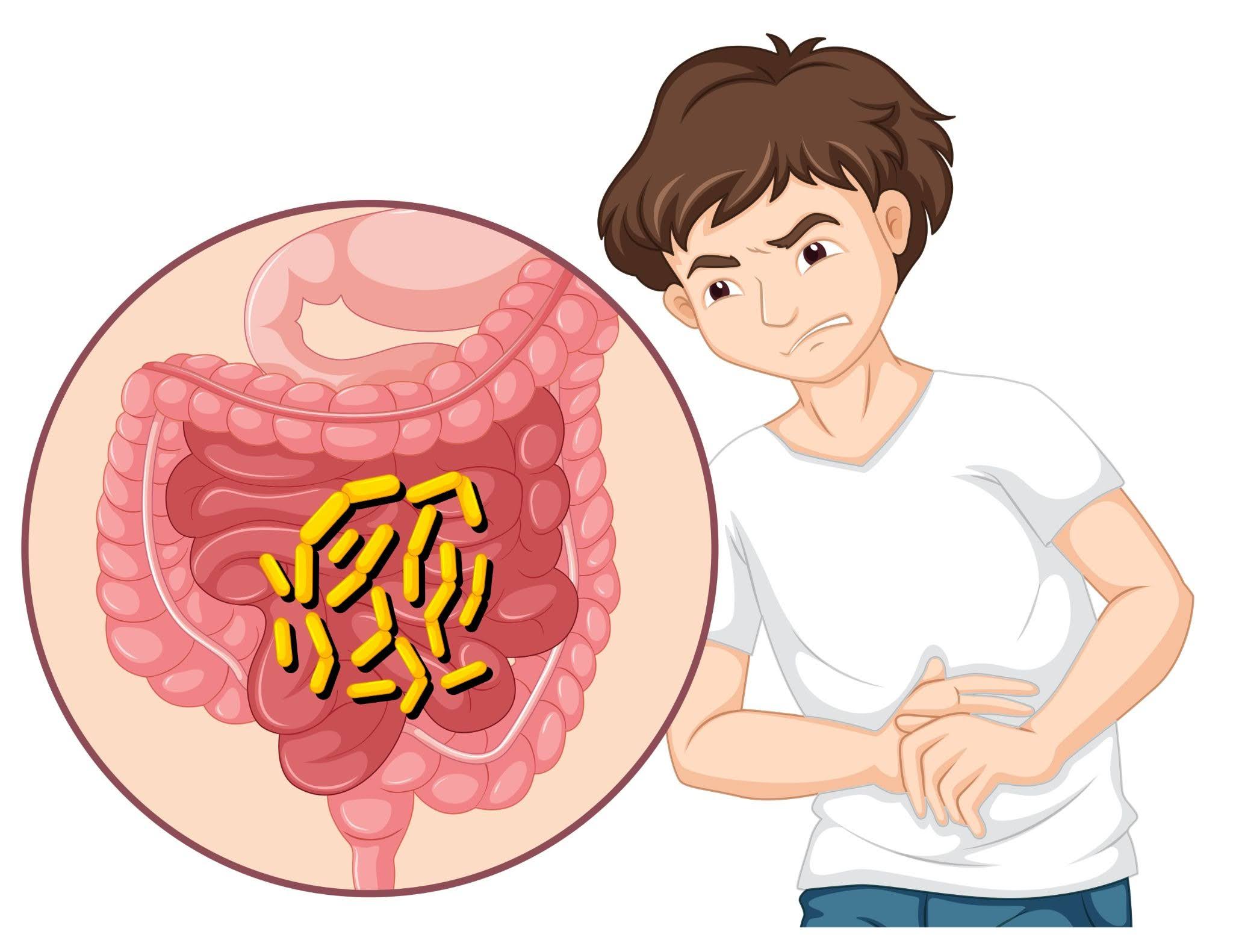 Gut Microbiome and Infection Risk Illustration Illustration of gut microbiome dysbiosis linked to hospital-acquired infection risk